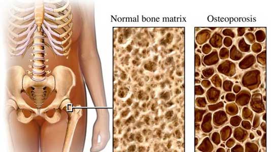 osteoporosis kangen water