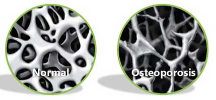 ostoporosis vs tulang normal